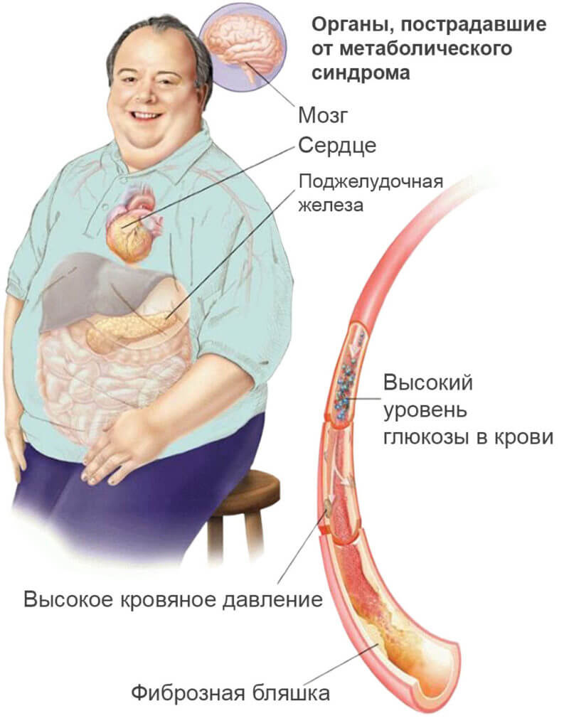 Заболевания Связанные С Лишним Весом
